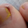 正确预防甲沟炎的方法