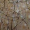 毛囊炎生活中饮食禁忌是什么