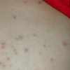 治疗水痘的方法是什么？