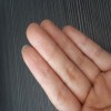 湿疹的治疗方法是什么呢