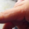炎症性扁平苔藓要怎么样预防好