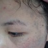 太田痣的危害有哪些？