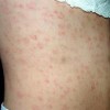 淋病患者日常中怎么护理？
