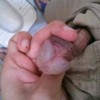 女性怎么检查生殖器疱疹