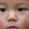 增生性疤痕有什么区别