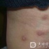 预防疥疮需要注意哪些方面