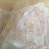 单纯疱疹的并发症是什么
