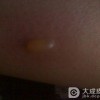 疱疹饮食注意哪些