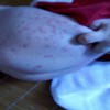 不同部位疱疹的不同症状表现