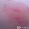 冬季饮茶可预防瘙痒