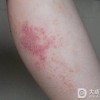 为什么瘙痒症会频繁发生