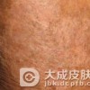 正确的认识瘙痒症的症状