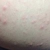 如何区分水痘和虫咬性皮炎