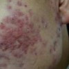 不同位置痤疮不同病因