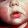 急性湿疹中医可以治疗吗