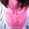 结节性红斑患者生活中应该如何护理呢