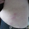 结节性红斑的西医治疗方法