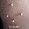 神经纤维瘤的形成原因