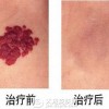 胎记与血管瘤怎么确诊