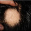 警惕斑秃引起的并发症