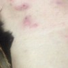 治愈梅毒护理很关键