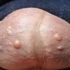 如何治疗妊娠期生殖器疱疹