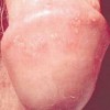 女性患了生殖器疱疹怎么治疗好