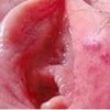 生殖器疱疹症状的介绍