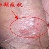 生殖器疱疹的女性症状是什么