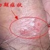 如何做好生殖器疱疹的预防