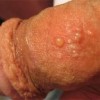 生殖器疱疹要怎样预防