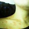 玫瑰糠疹在初期是什么症状