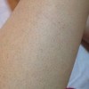 宝宝毛囊角化怎么办