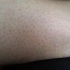 鳞状毛囊角化病有什么临床表现