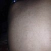 毛囊角化症都有哪些症状