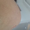 萎缩性毛发苔藓重在护理