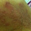 梅毒症状多变复杂 抗生素可治疗