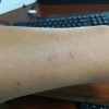 后天一期梅毒的典型症状
