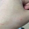 梅毒病发后的症状是什么