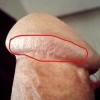 男性急性淋病症状