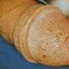 男性淋病的早期症状