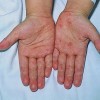 家长如何识别水痘与水痘治疗