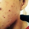患水痘该怎么治疗啊