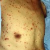水痘的发病过程是怎样的