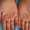 手足癣有哪些具体的表现症状