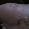 手足癣都有哪些症状