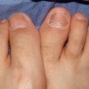 手足癣有哪些显而易见的早期症状