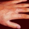 手足癣有哪些典型症状