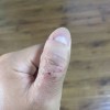 怎么才能彻底治愈手癣