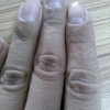 手癣夏季危害严重应更加注意